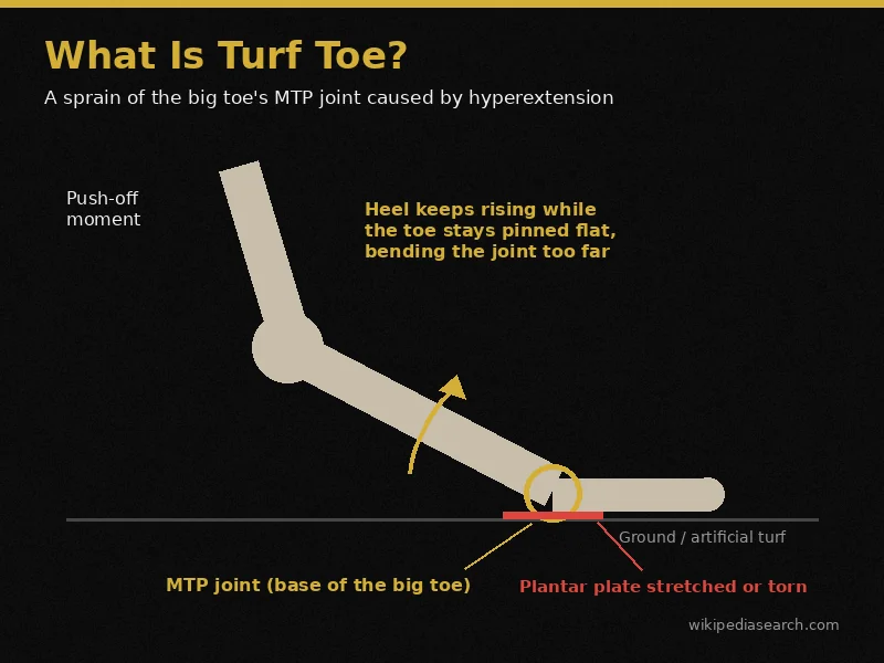What is turf toe diagram showing big toe MTP joint hyperextension and plantar plate injury